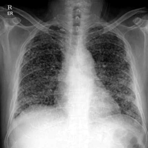 Tuberculosis and Respiratory Diseases Vol. 70. No. 2, Feb. 2011 환자의증례를통하여, 류마티스관절염을동반한다발성폐결절환자에서드물지만원인질환의하나로 Caplan's syndrome도고려해야함을환기하려고한다.