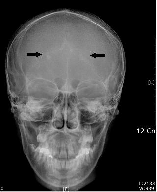 - 김영삼외 6인 : 가성부갑상선기능저하증 I형의 1예 - Fig. 2. The skull X-ray findings. The abnormal calcifications (arrows) were observed. Table 4. Ellsworth-Howard test P (mmol/h) U 1 0.222 C (nmol/mg creatinine) U 2 0.