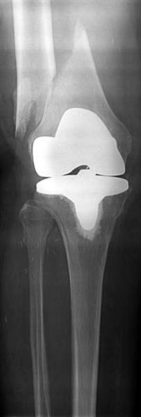 슬관절 전치환술 후 발생한 대퇴골 삽입물 주위 골절의 치료 Fig. 1.