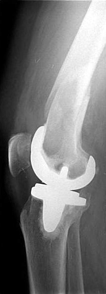 type I with periprosthetic femoral fracture.