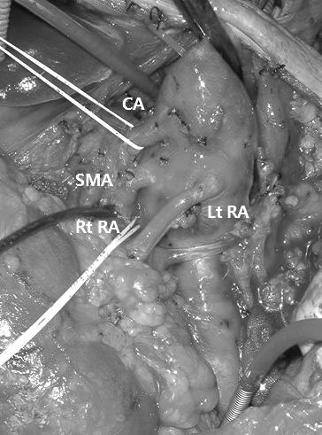 originated from descending aorta to right common iliac artery (A).