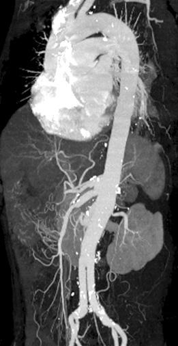 Preoperative 3D image of CT angiography shows a TAAA from proximal descending aorta to both common iliac