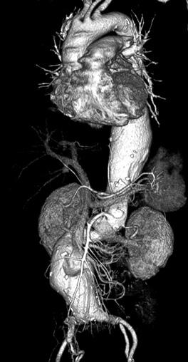 Postoperative MIP image of CT angiography shows well-functioning aortic and visceral arterial grafts (C).