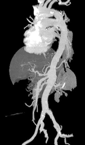 Hyang Hee Choi, et al:separate Visceral Revascularization in TAAA Repair 51 Fig. 3. 58-year-old female patient with type I aortic dissection.