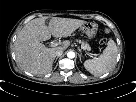 - The Korean Journal of Medicine: Vol. 76, No. 5, 2009 - C Figure 1. () bdominal computed tomography (CT) showed hepatomegaly with coarse enhancement, suggestive of hepatitis. () 2.