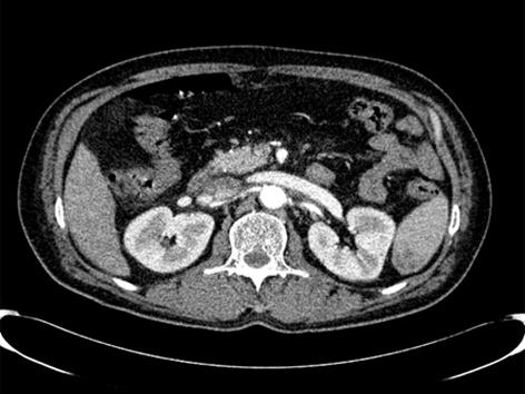 (C) Diffuse ground glass opacities in both upper lungs were detected. minimal amount of pleural effusion was observed in both lungs.