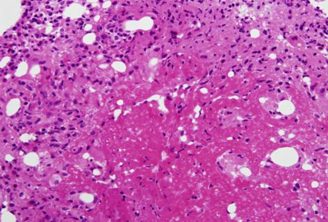 - Heekyoung Choi, et al. case of tuberculosis hepatitis - Figure 2. () Liver function tests indicating aspartate transaminase (ST) and alanine aminotransferase (LT) levels from admission to discharge.