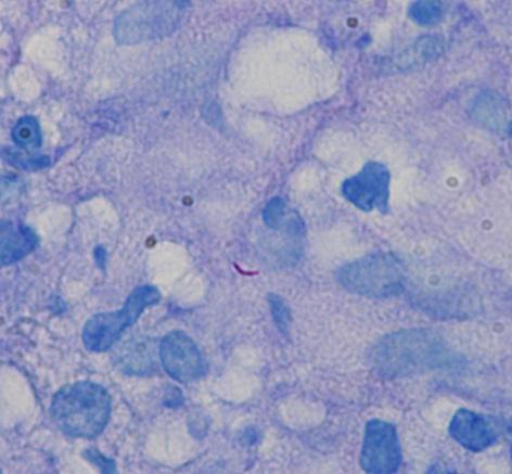 () Histopathological analysis of a liver biopsy revealed chronic granulomatous inflammation with caseous necrosis (H&E, 400).