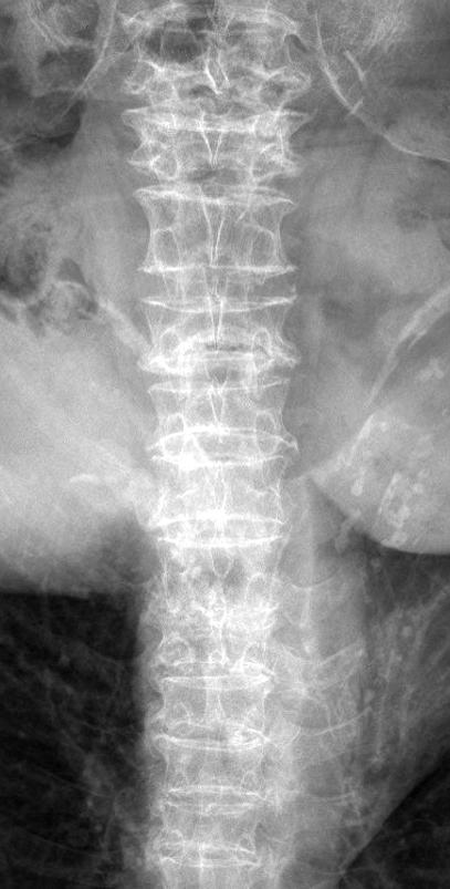 337 Treatments for Pyogenic Spondylitis A B Figure 2. A 62-year-old female developed T10 11 pyogenic spondylitis.