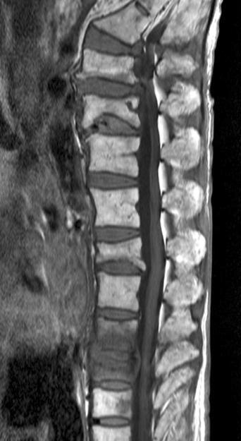 T11 with anterior epidural inflammatory thickening.