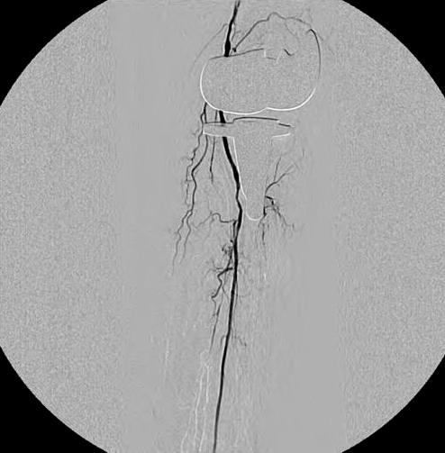 of left peroneal artery (A, B).