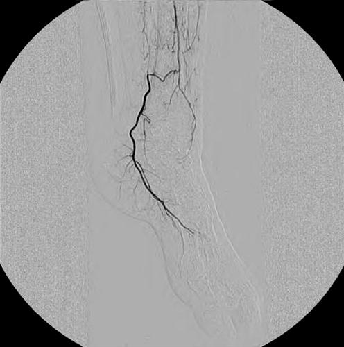 After stent insertion and balloon angioplasty, left superficial femoral artery, popliteal
