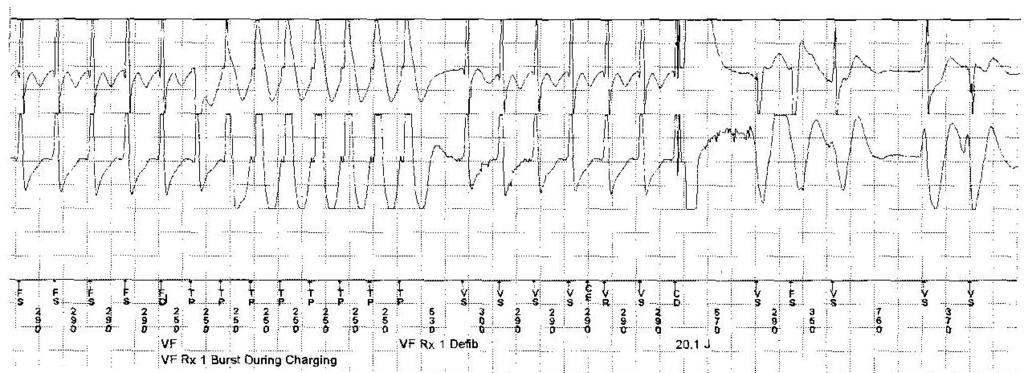 and (B) Intracardiogram during tachycardia of 207 bpm.