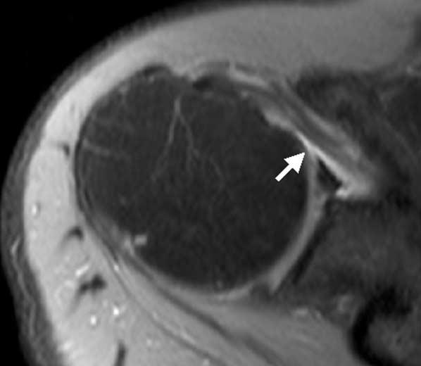 대한영상의학회지 2009;60:173-180 상완이두근장두건은정상, 건염, 파열과탈구유무를분석하였다. 조영증강지방억제양자밀도영상에서각부위의손상정도를먼저평가한후, 회상치우침 (recall bias) 을최소화하기위하여 2주후에축상면조영증강지방억제 T1 강조영상에서손상정도를평가하였다.