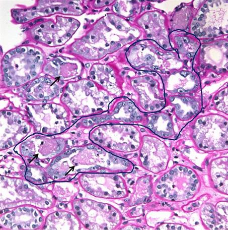 (B) Most tubules are discontinuously arranged on the tubular basement membrane (epithelial sloughing).