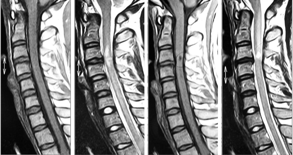 방사선소견상외상소견이없는척수손상 박희전외 Fig. 1. 58-year old man with acute spinal cord injury. MRI of the cervical spine was obtained trauma day(a, B) and 12 months (C, D) after injury.