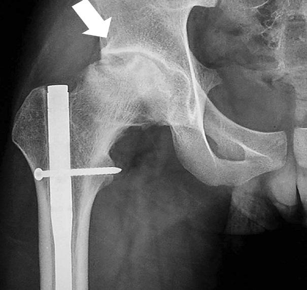 Although the femoral fracture was well reduced by flexible nails (left), the nails were bent