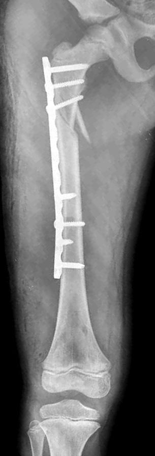 5) Flynn JM, Hresko T, Reynolds RA, Blasier RD, Davidson R, Kasser J: Titanium elastic nails for pediatric femur fractures: a multicenter study of early results with analysis of complications.