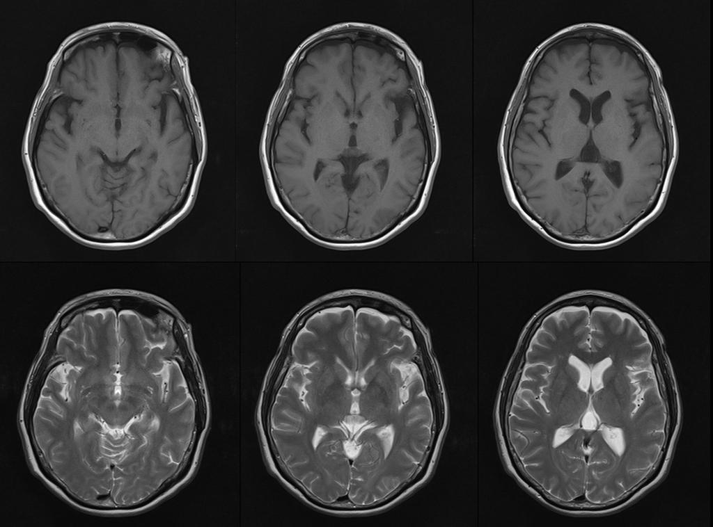 (A) (B) Figure 1. T1- (A) and T2-weighted (B) MRIs show asymmetric left perisylvian atrophy. 해듣는방식으로생활하였다. 내원 3년전부터며칠전일이잘생각이안날정도의기억력장애가발생하였고, 1년전우측어깨부위에통증이생기기시작하였다.