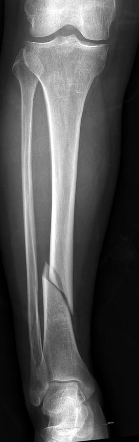 39 Ankle Fracture Associated with Tibia Shaft Fractures Fig.