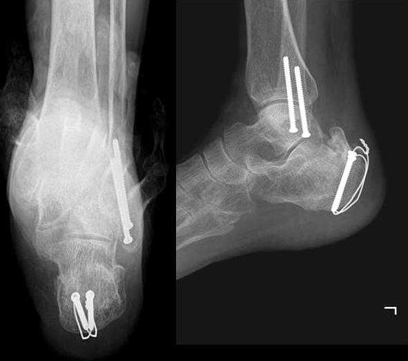 internal fixation of calcaneal tubercle. Fig. 7.