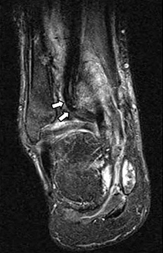 Ankle MRI shows incarceration of posterior tibial tendon into the fibular groove of distal tibia (white arrows) and displaced