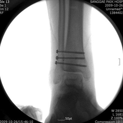 족관절탈구후후경골건감돈과장족무지굴건이탈에동반된 Checkrein 변형 275 Fig. 7. Intra-operative ankle X-ray (AP and lateral views). Fig. 8. Follow-up standing ankle radiograph.