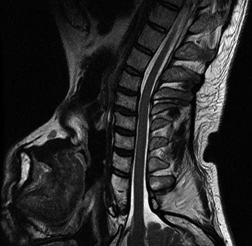 () Cervical spine MRI shows cervical disc degeneration without both disc herniation or spinal cord lesion. Fig. 3.