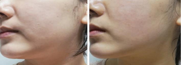 붙이면작아지는 V 리프팅패치 V-Lifting Patch for Slimming Facial Line 使用一次可以提拉 / 弹力 / 保湿