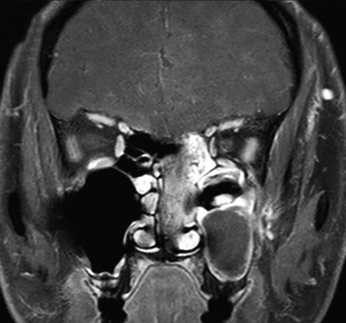 typical cerebriform, convoluted pattern of inverted papilloma is shown in the left ethmoid and frontal sinuses by