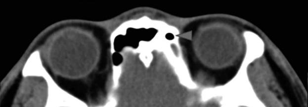 탈모증 절개부위 및 안면신경의 전두근 가지의 마비 등 수술 후 합병증의 가능성이 있다 이러한 합병증을 줄이기 위해 확장된 절개법 C D E F Fig. 5. Postoperative enhanced computed tomography scans obtained at 2 years after the surgery.