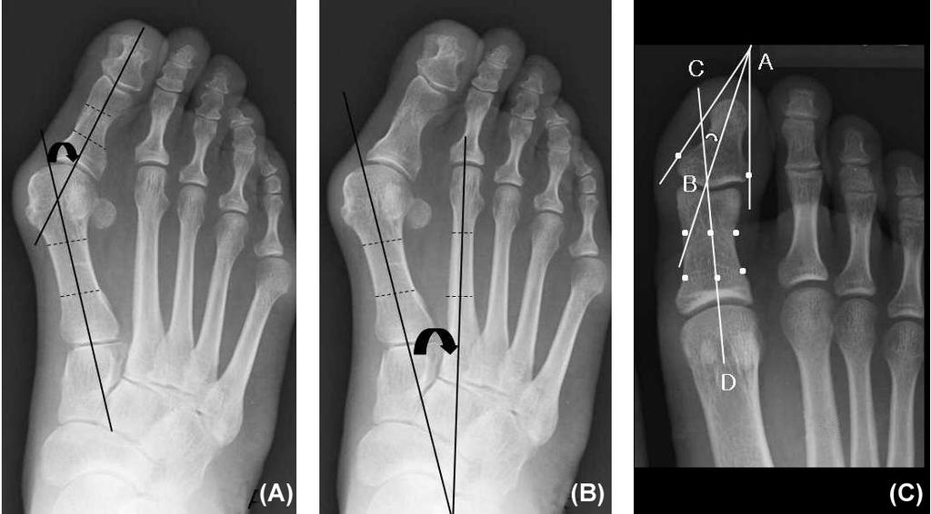 Figure 1. (A) Hallux Valgus Angle. The hallux valgus angle is formed by intersection of the diaphyseal axes of the proximal phalanx and the first metatarsal. (B) Intermetatarsal Angle.