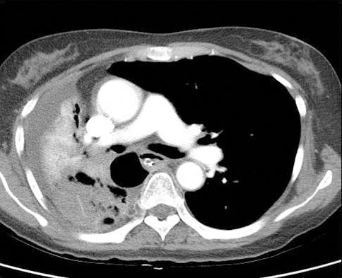 (C) Follow-up chest radiography on post-bronchoscopy day 1 shows improved atelectasis of the right middle and