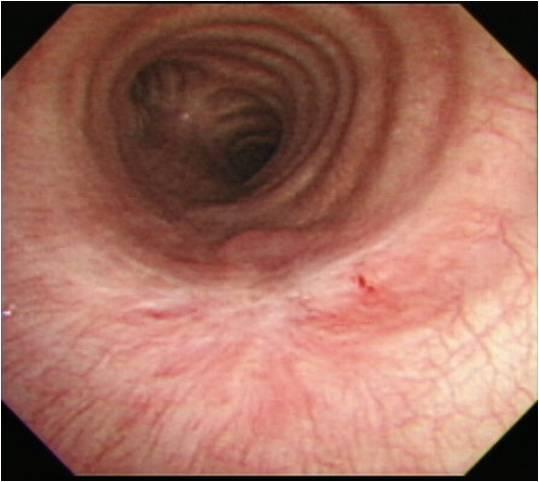 (A) Bronchoscopic findings showing an oval mass (18 15 mm) covered with normal mucosa and arising