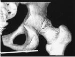 굴곡은양측골반의모양이완전히겹치는정측면영상에서대좌골절흔의원위직선기시부와좌골조면의후방부를잇는직선을기준으로측정하였다 (Fig. 1).