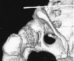 외전 / 내전은전후면혹은상하면영상에서양측좌골조면의원위부를잇는선에직각인가상의선과대퇴장축이이루는각을택하였다 (Fig. 3).