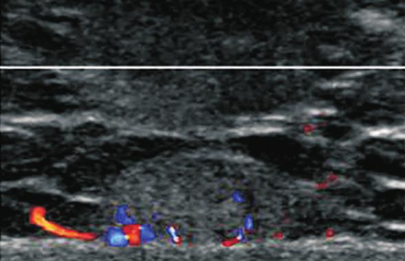 Transverse ultrasonography image of popliteal fossa shows a cystic mass arising between tendons of the medial head of gastrocnemius (GM) and semimembranosus (SM) muscles. Figure 2.