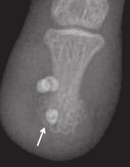 (C) Radiographic correlation confirms the presence of a few phleboliths (arrow). Figure 7.