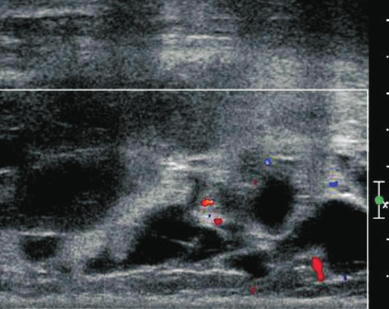 The Color Doppler image shows an irregular hypoechoic mass with abnormal fluidfilled spaces and shows only a few, weak