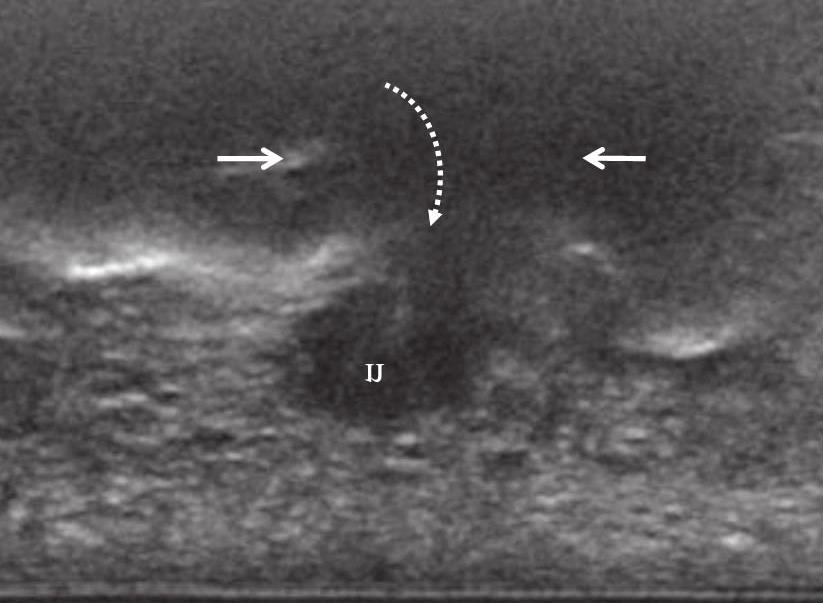 65-year-old female with Morton neuroma (n) in the third intermetatarsal space.