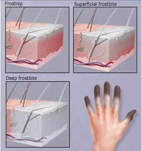 Pathology 냉동전단계 (Before freezing stage) 추위노출 -> 피부표피온도하강 -> 인체조직온동 10 도씨이하하강 -> 피부감각소실