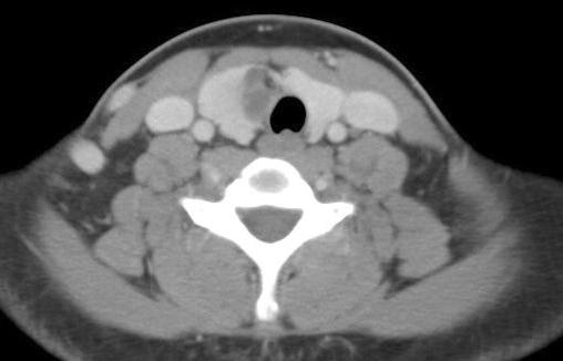 Cervical Bronchogenic Cyst Fig. 1. CT scans with contrast enhancement shows 5 5 cm well-defined cyst, originated from right thyroid gland, extending to upper mediastinum.