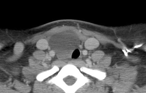 컴퓨터단층촬영 (CT) 에서갑상선우엽하부에유래하는것으로보이는, 경계가분명한 5 5 cm 크기의낭종이하방으로는종격동까지진행하고있었고, 상방으로는기관벽을따라부착되어있었으며, 기관의우측전위가동반되었다 (Fig. 1).