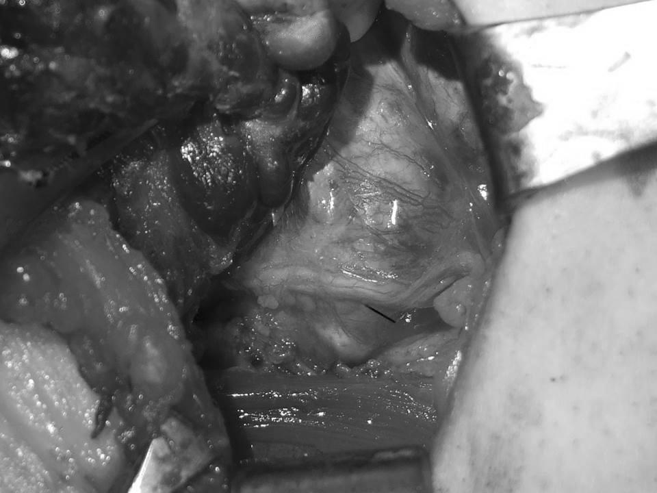 (B) This operative photo reveals that the cystic wall is attached to the recurrent laryngeal nerve.