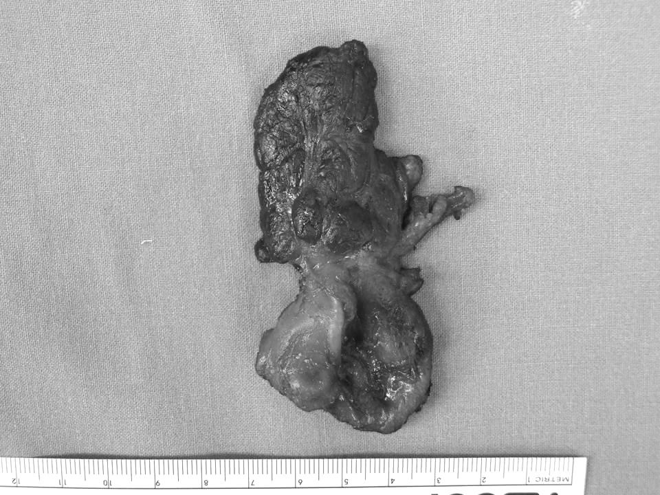 arrows: recurrent laryngeal nerve, C: cyst, Th: thyroid gland, Tr: trachea 알려져 있다.