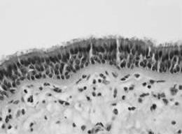 Histopathologic photo shows that cystic wall contains mucoserous glands (arrowhead) and hyaline cartilage (arrows), which is consistent with