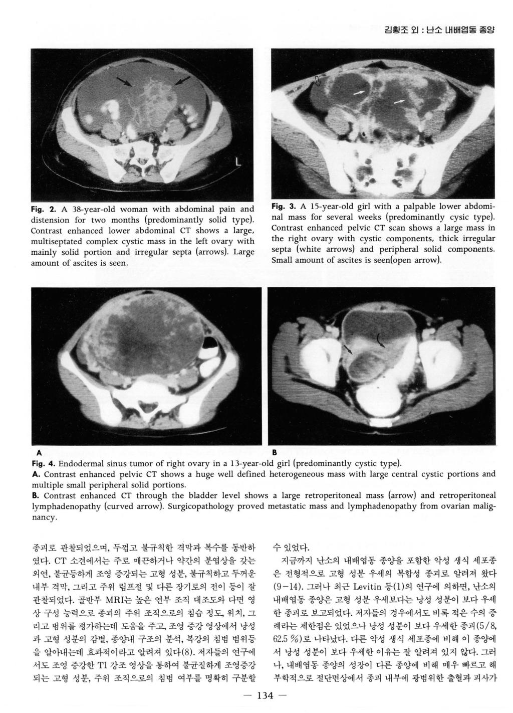 김횡조오 1: 닌소내배엽동종앙 Fig. 2. A 38-year-old woman with abdominal pain and distension for two months (predominantly solid type).