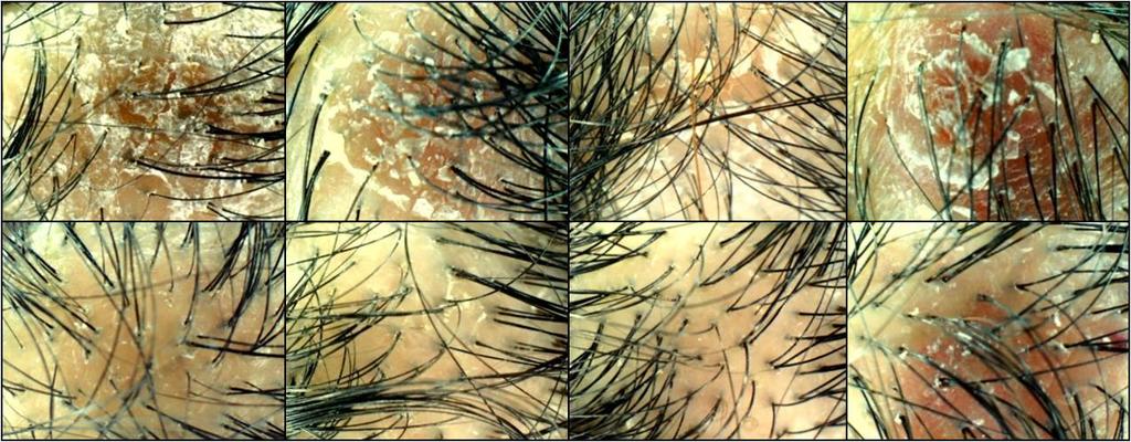 대한의진균학회지 제19권 제2호 2014 Fig. 4. Clinical photographs: before treatment (upper row), after 8 weeks of LED phototherapy (lower row). Erythema and scale of the scalp lesions were improved obviously.