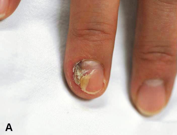 이수현외 : 모즈미세도식수술로치료한손톱밑편평세포암 4 예 427 2.