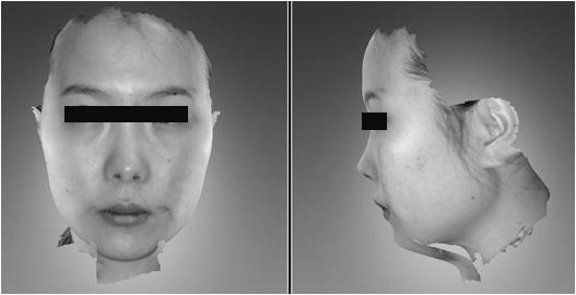 YK Park et al. 197 Figure 1. Anterior view and lateral view of face scanned by 3D facial scanner (RFS-S100) (Jan-15-2014) Figure 2. Changes of vertigo and gait ataxia after the treatment.
